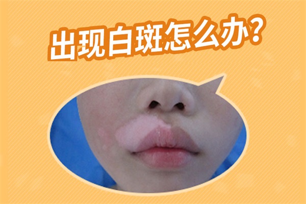面部白癜風,臉上白癜風對癥治療
