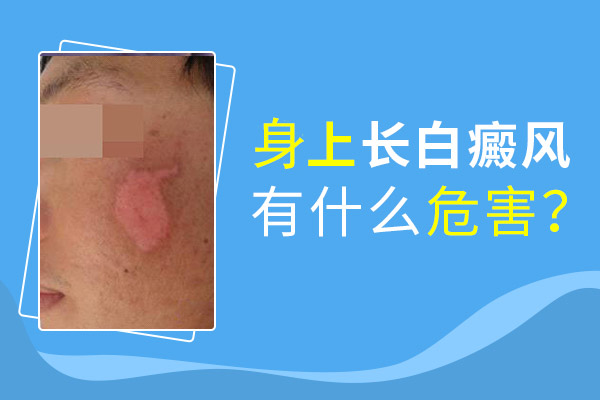 白癜風能不能治療、白癜風要怎么治療
